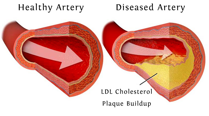 Healthy Artery
